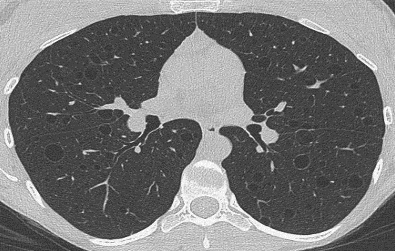 Pulmonary Insights | HRCT is Cost-Effective in Screening for Diffuse Cystic Lung in Patients Presenting with a Spontaneous | Pulmonary Insights