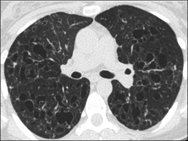 What Is Hrct Chest Scan at Scott Barden blog