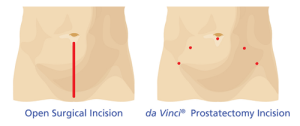 dv-prostatectormy