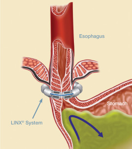 Figure 2: LINX® is designed to keep the weak LES closed to prevent reflux.