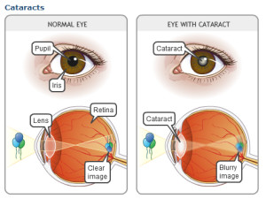 cataracts